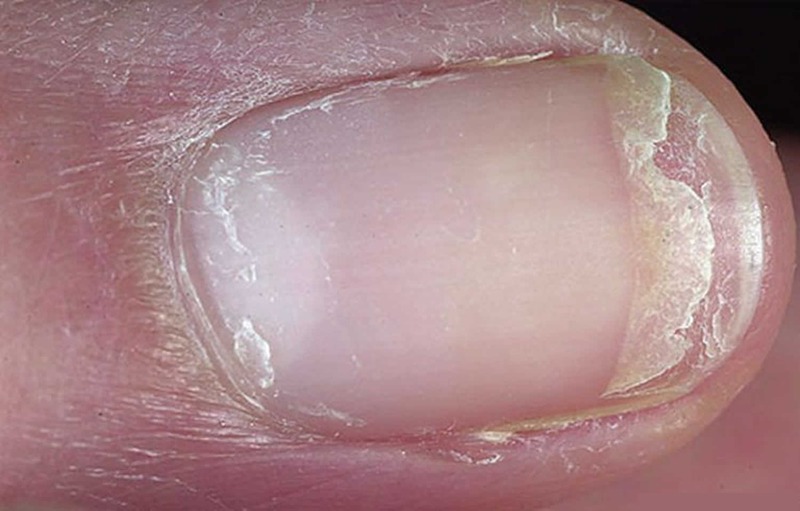 Methods to Reduce Onychorrhexis or Brittle Nails