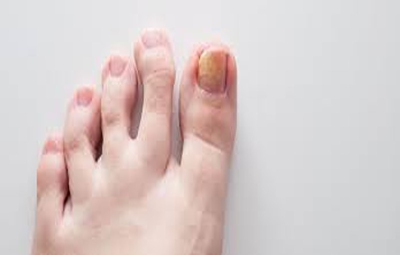 Home Remedies For Toenail Fungus