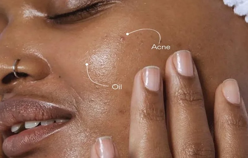 Essential Oils That Are Good For Your Acne Prone Skin