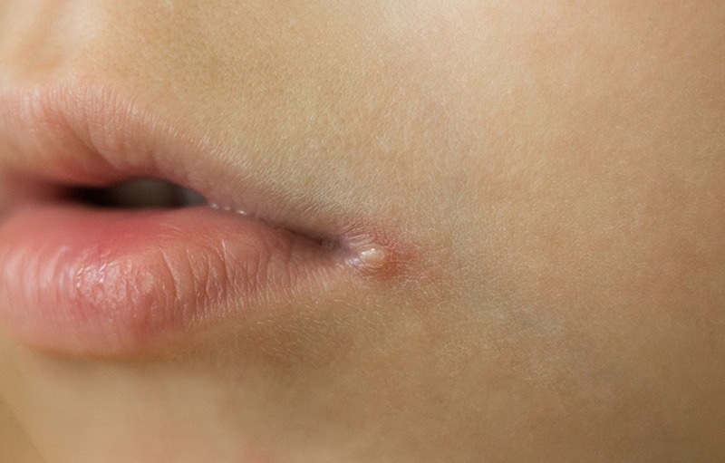 How To Treat Angular Cheilitis With Natural Home Remedies?