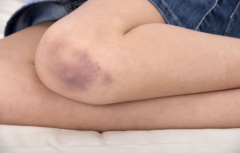 How To Heal Bruises Naturally With Home Remedies?