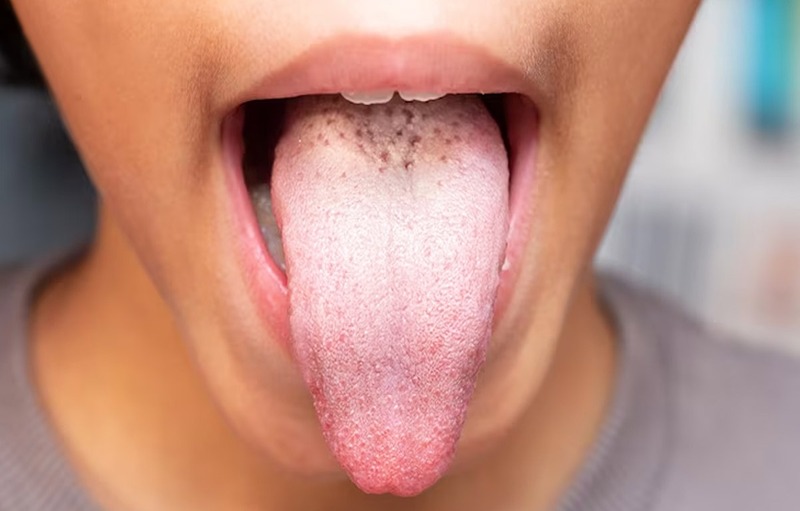 How To Permanently Get Rid Of White Tongue On Your Own?