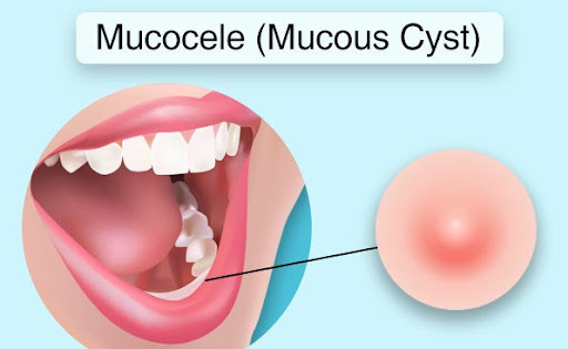 What Are The Symptoms Of Mucocele & How To Treat It Naturally?