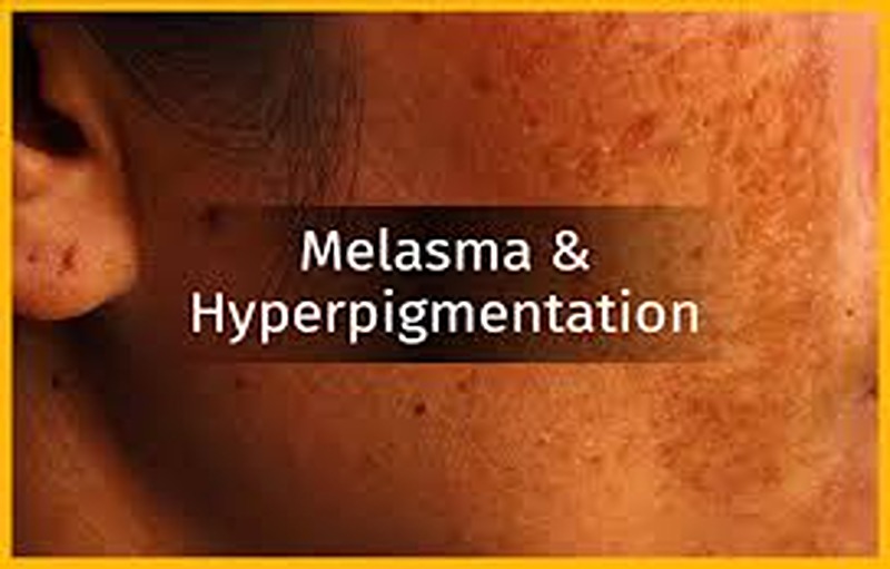 Home Remedies For Melasma And Pigmentation