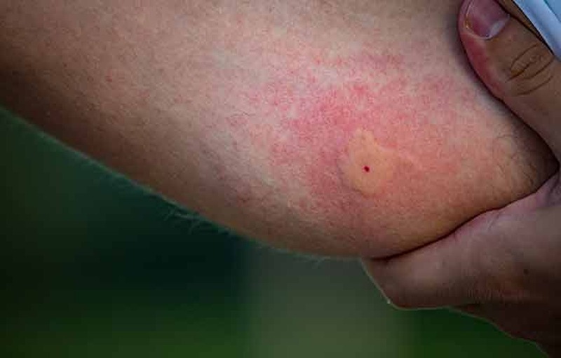 Home Remedies To Treat Mosquito Bites