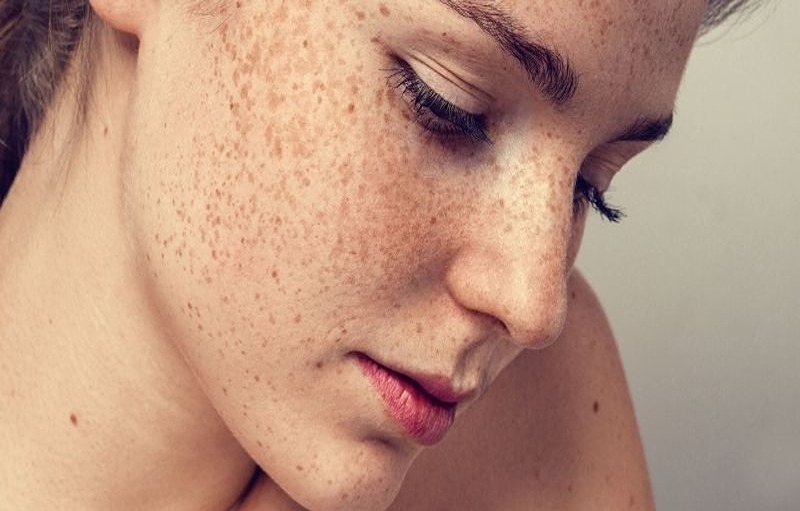 Home Remedies To Treat Freckles