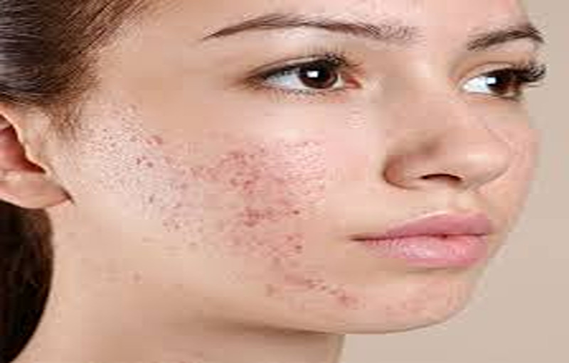 Best Acne Home Remedies