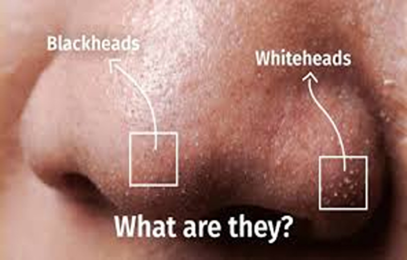 Best Ways to Get Rid Of Whiteheads on Nose and Chin Fast