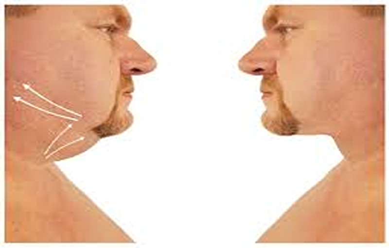 You Will Leave Home More Often After Knowing These Remedies for Facial Fat