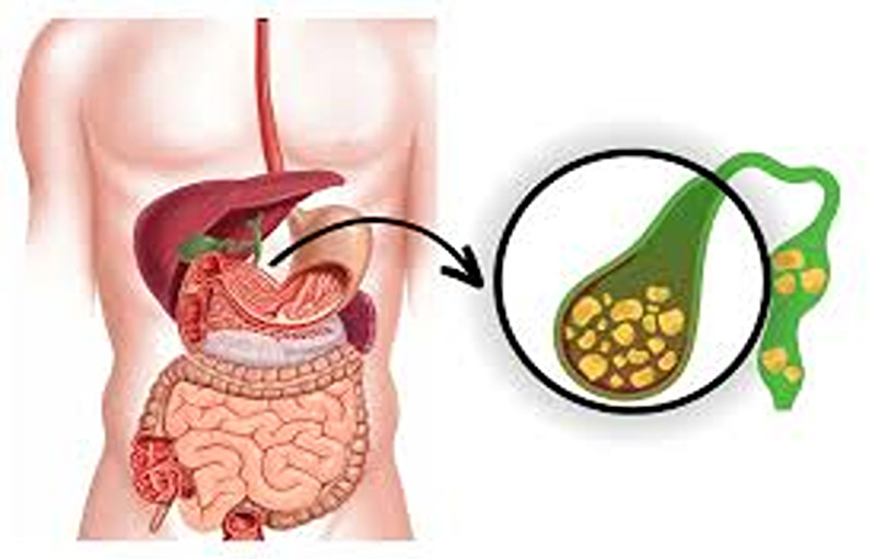 Symptoms Of Gallbladder Problems