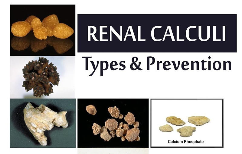 What Is Bilateral Renal Calculi And Its Implications On Kidney Health