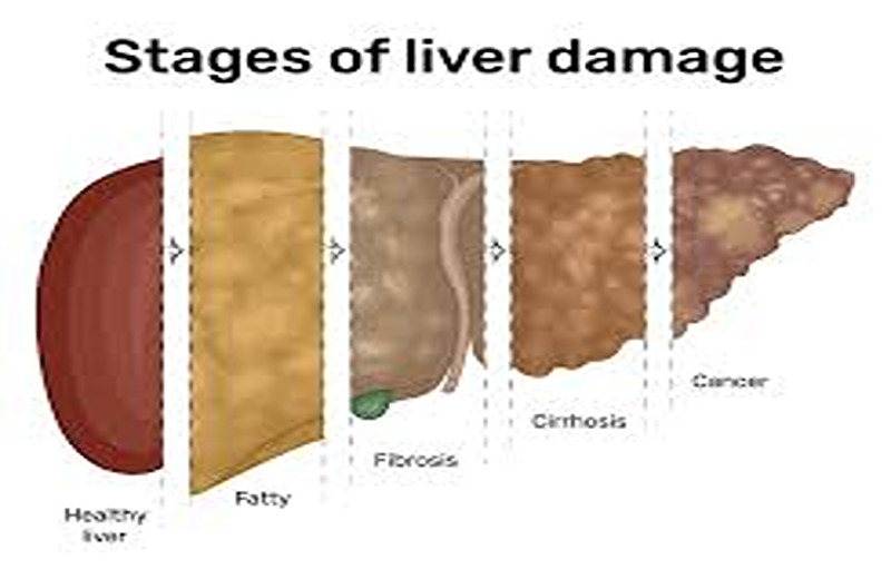 5 Powerful Natural Ways To Treat Liver Diseases