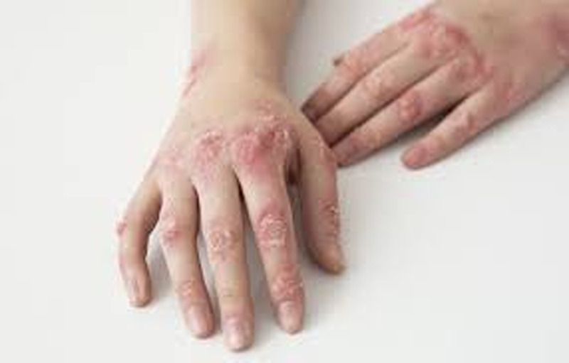 Top 8 Natural Home Remedies for Ringworm
