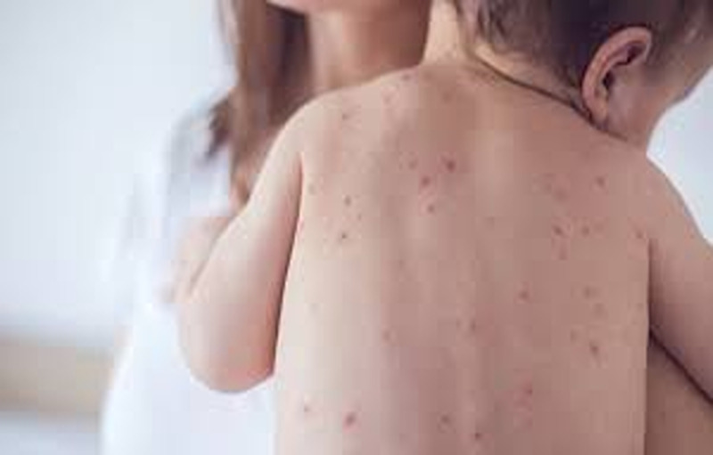 Home Remedies For Chickenpox To Heal Faster