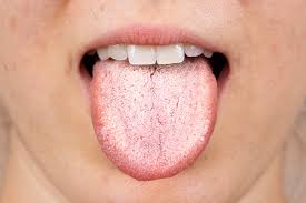 Top Effective Home Remedies For Candida Yeast Infection Treatment