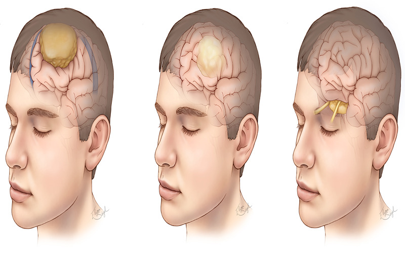 How to prevent brain tumor naturally?