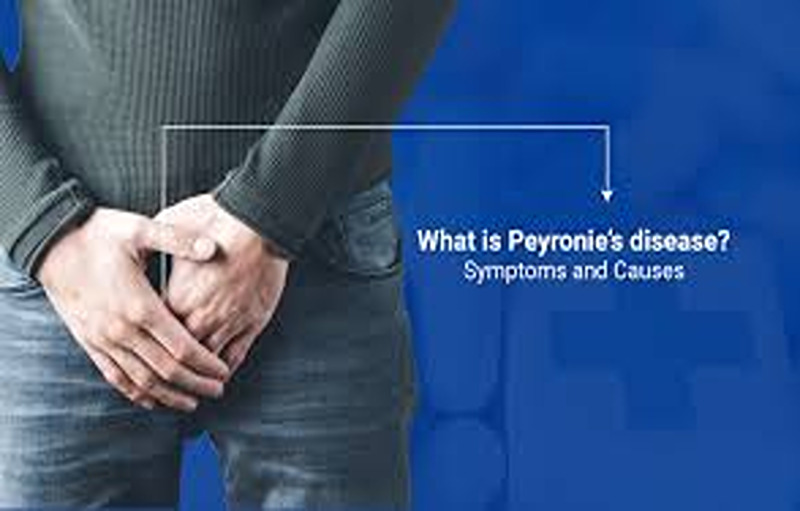 Penile Curvature: Peyronie’s Disease or Congenital?