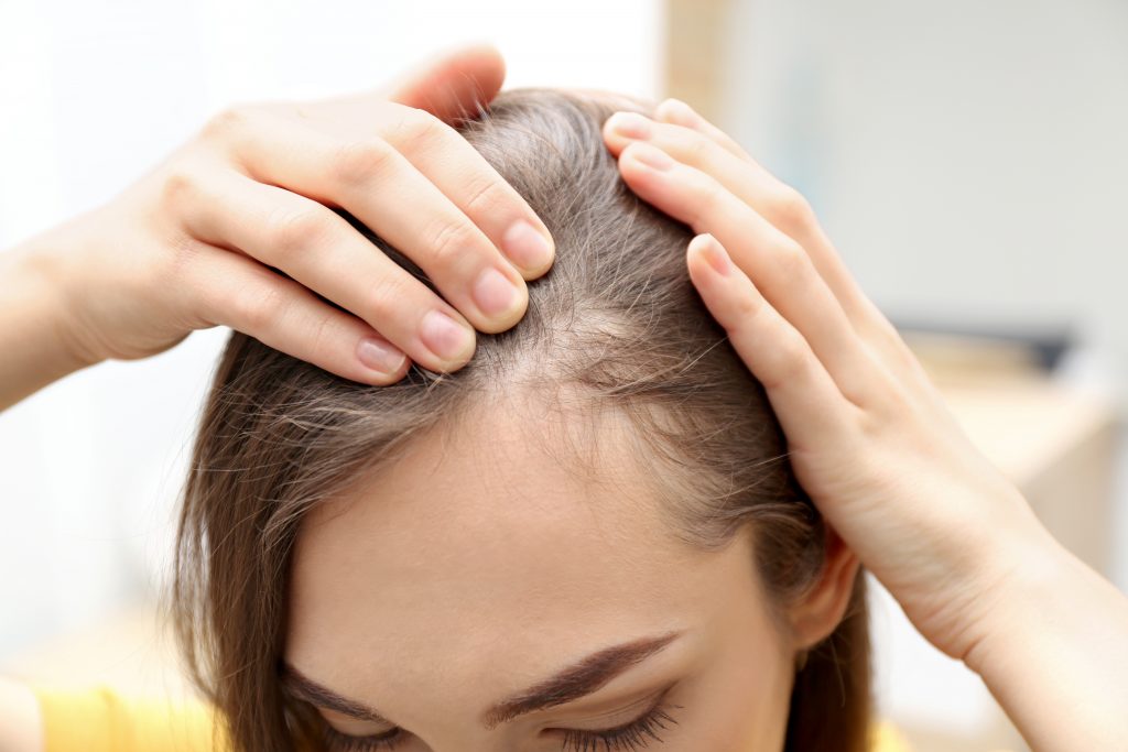 HOME REMEDIES FOR ALOPECIA OR HAIR LOSS