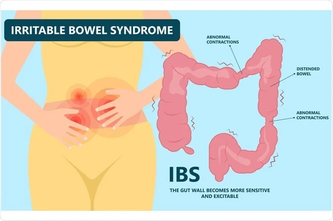 What Is IBS? Symptoms, Causes, and Treatment Options